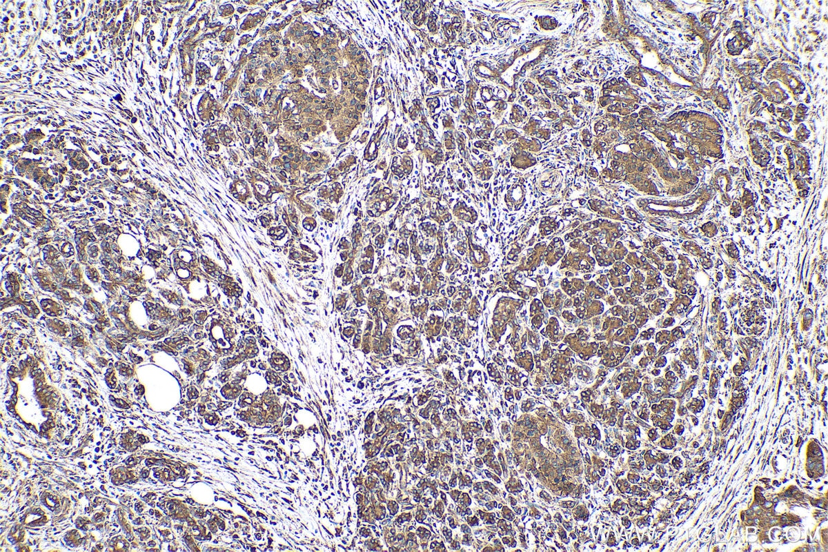 Immunohistochemical analysis of paraffin-embedded human pancreas cancer tissue slide using KHC0531 (GRP94/HSP90B1 IHC Kit).
