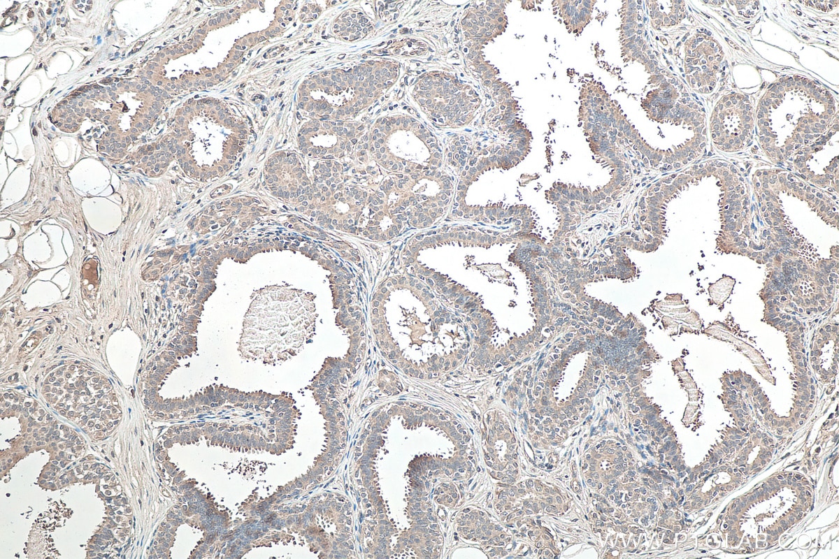 Immunohistochemical analysis of paraffin-embedded human breast cancer tissue slide using KHC0116 (GSK3B IHC Kit).