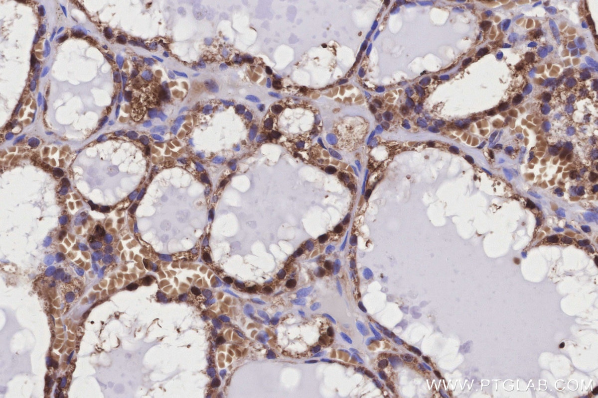 Immunohistochemical analysis of paraffin-embedded human thyroid cancer tissue slide using KHC3159 (GSR IHC Kit). Immunohistochemical analysis of paraffin-embedded human thyroid cancer tissue slide using KHC3159 (GSR IHC Kit).