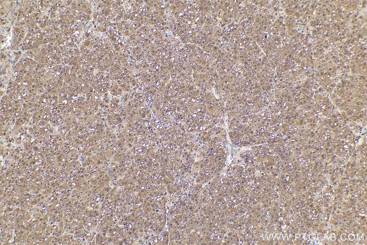 Immunohistochemical analysis of paraffin-embedded human liver cancer tissue slide using KHC0781 (GSS IHC Kit).