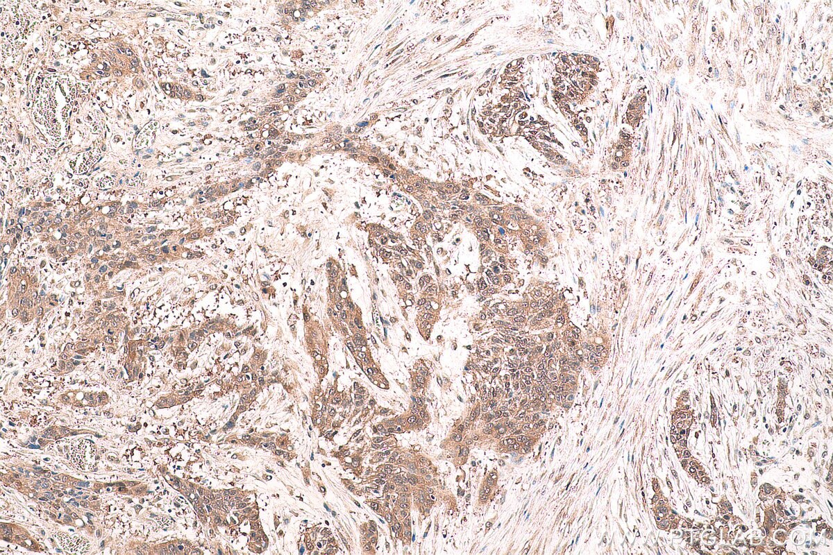 Immunohistochemical analysis of paraffin-embedded human oesophagus cancer tissue slide using KHC0781 (GSS IHC Kit).
