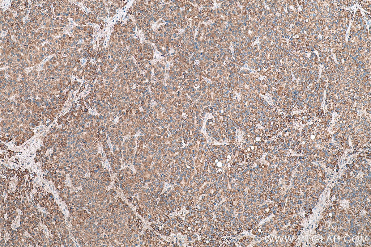 Immunohistochemical analysis of paraffin-embedded human liver cancer tissue slide using KHC0787 (GSTCD IHC Kit).