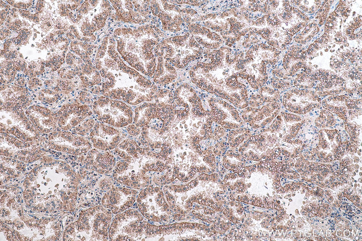 Immunohistochemical analysis of paraffin-embedded human lung cancer tissue slide using KHC0787 (GSTCD IHC Kit).