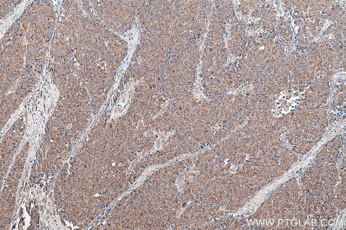 Immunohistochemical analysis of paraffin-embedded human stomach cancer tissue slide using KHC0787 (GSTCD IHC Kit).