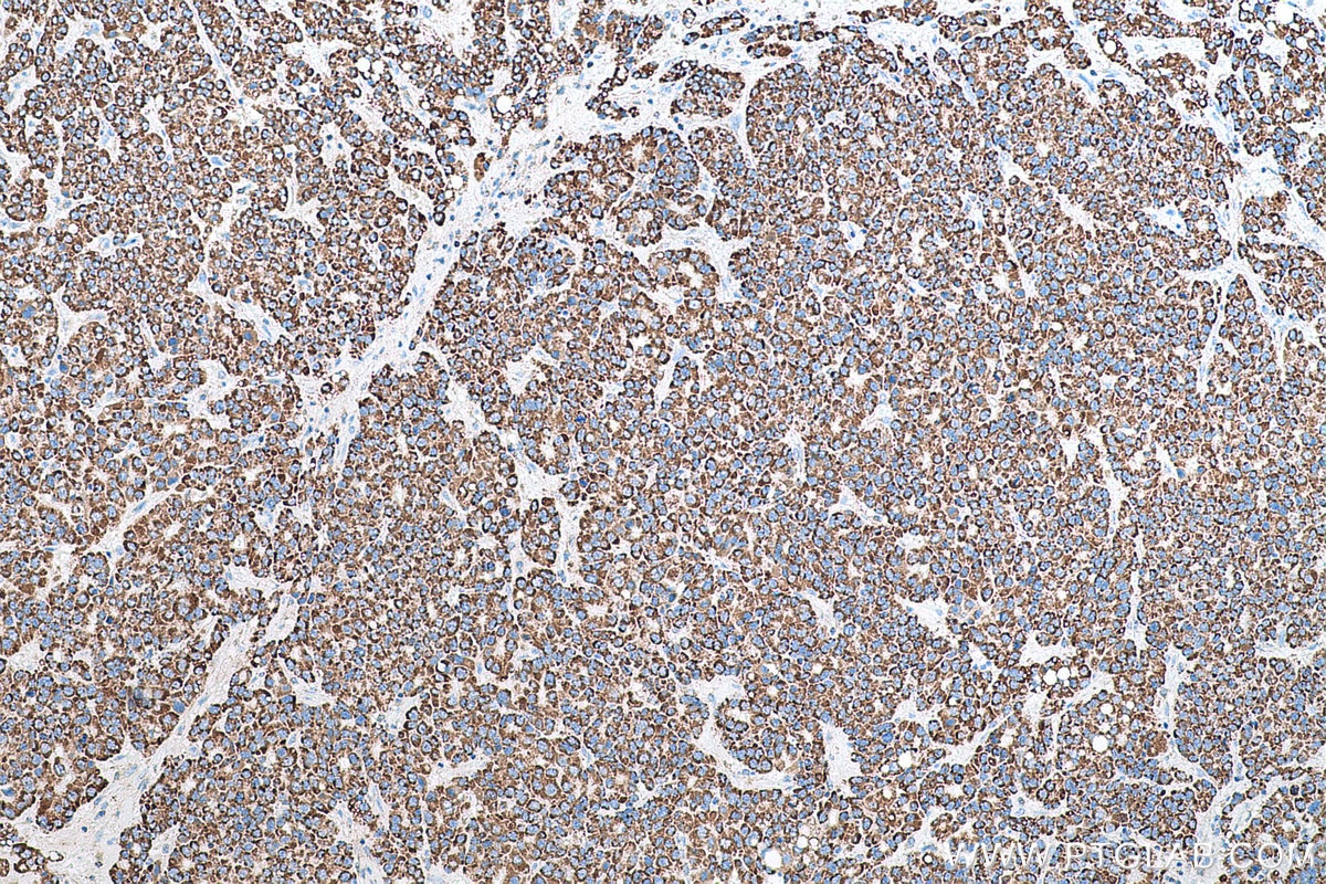 Immunohistochemical analysis of paraffin-embedded human liver cancer tissue slide using KHC0788 (GSTK1 IHC Kit).