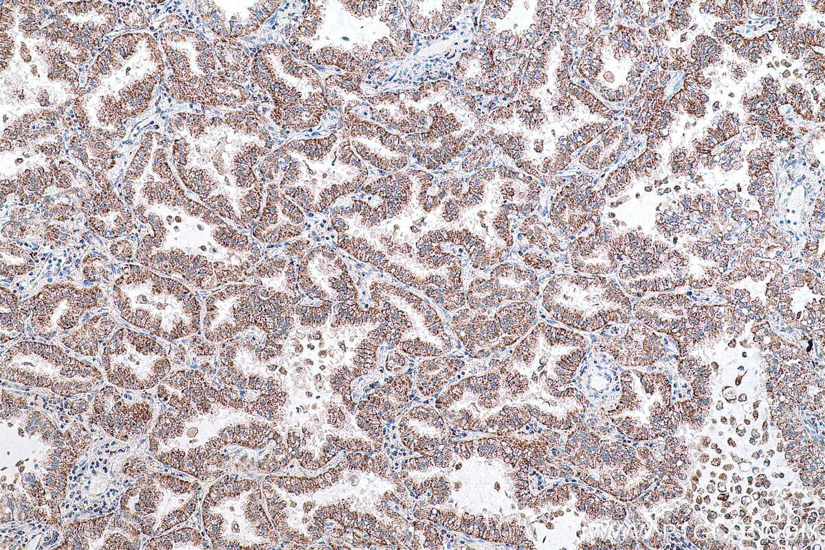 Immunohistochemical analysis of paraffin-embedded human lung cancer tissue slide using KHC0788 (GSTK1 IHC Kit).