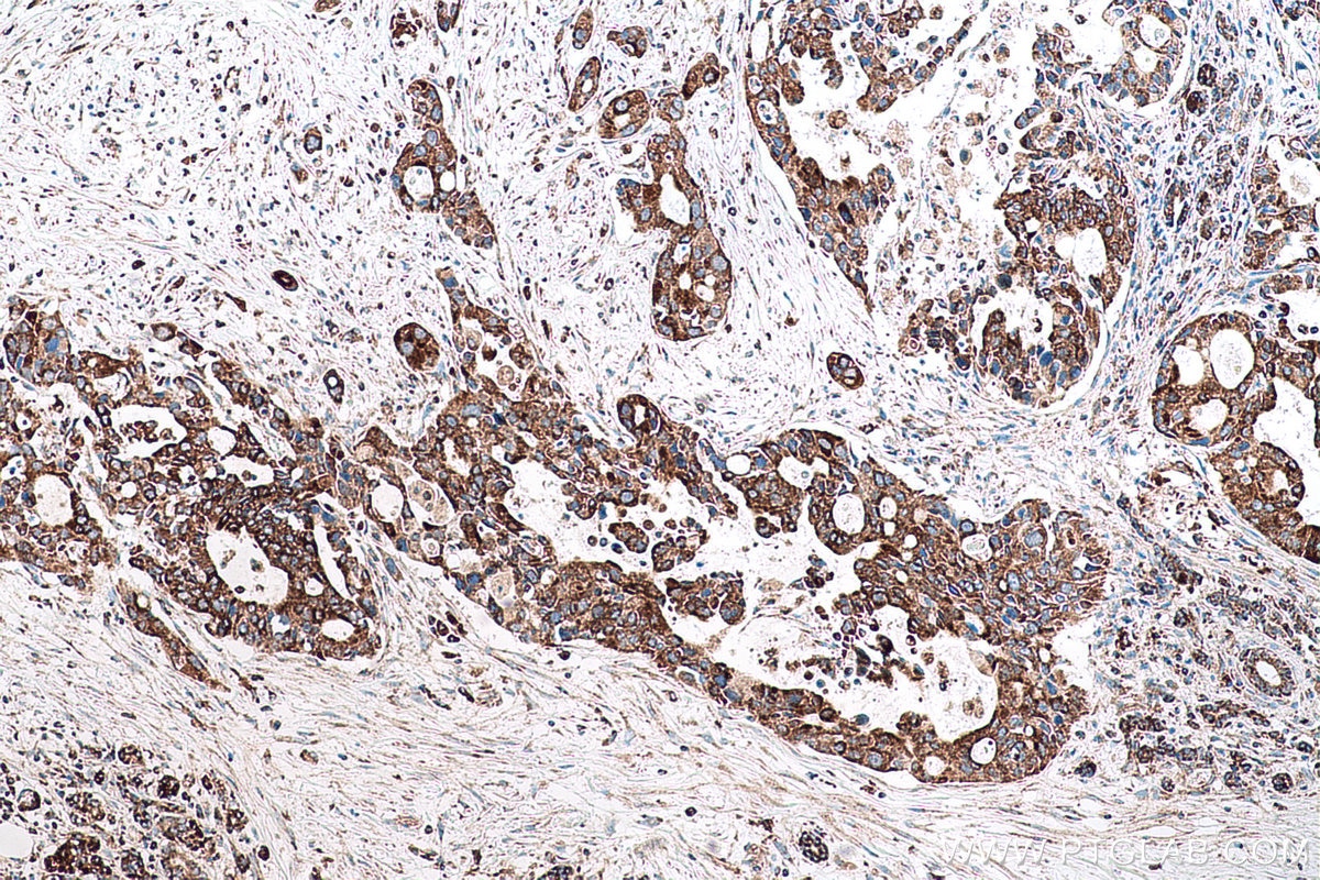 Immunohistochemical analysis of paraffin-embedded human pancreas cancer tissue slide using KHC0788 (GSTK1 IHC Kit).