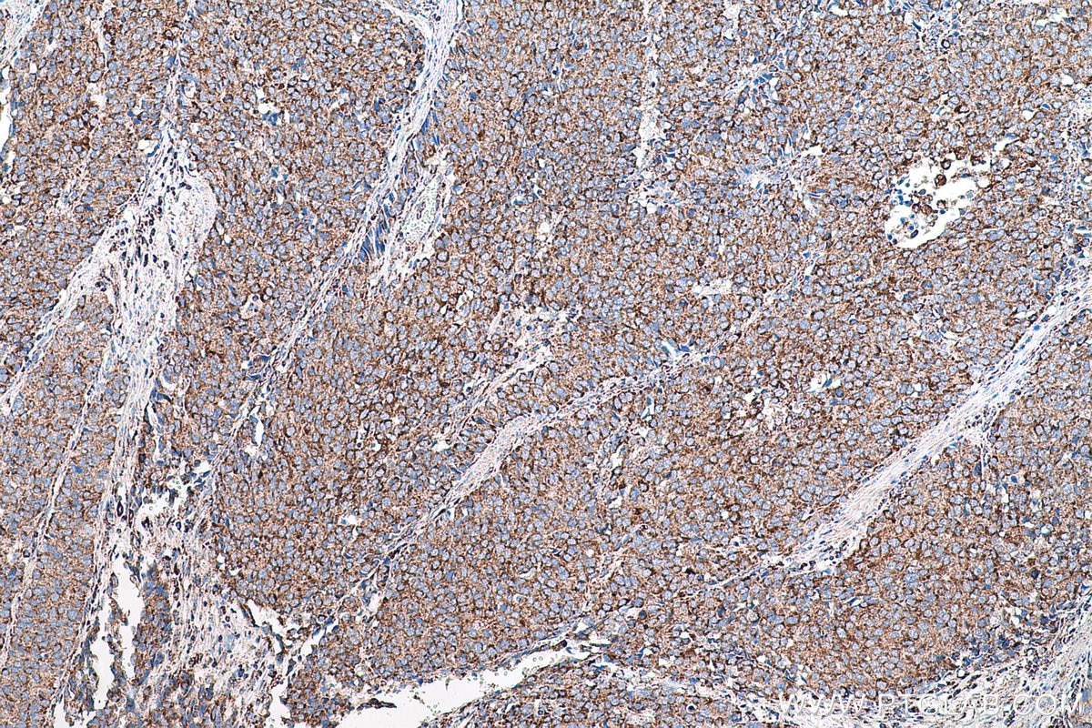 Immunohistochemical analysis of paraffin-embedded human stomach cancer tissue slide using KHC0788 (GSTK1 IHC Kit).