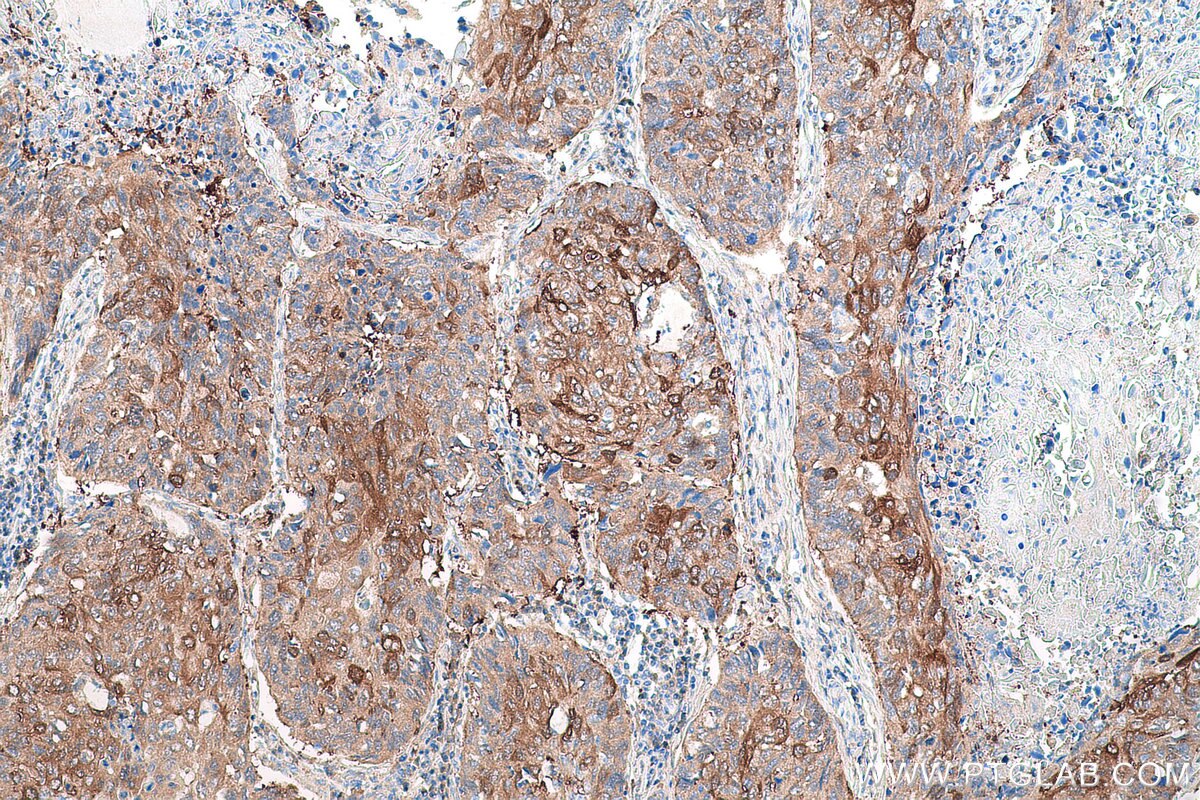 Immunohistochemical analysis of paraffin-embedded human lung cancer tissue slide using KHC0789 (GSTM3 IHC Kit).