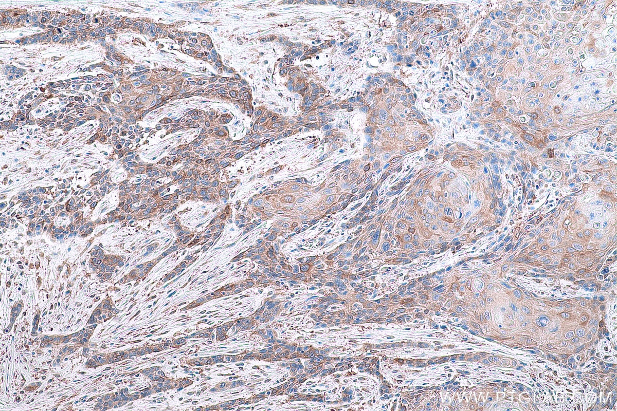 Immunohistochemical analysis of paraffin-embedded human oesophagus cancer tissue slide using KHC0789 (GSTM3 IHC Kit).