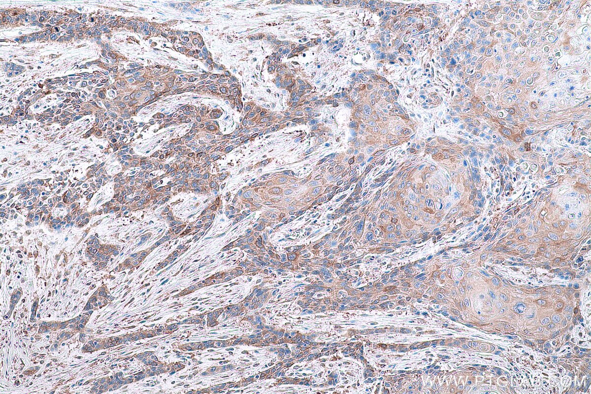 Immunohistochemical analysis of paraffin-embedded human oesophagus cancer tissue slide using KHC0789 (GSTM3 IHC Kit).