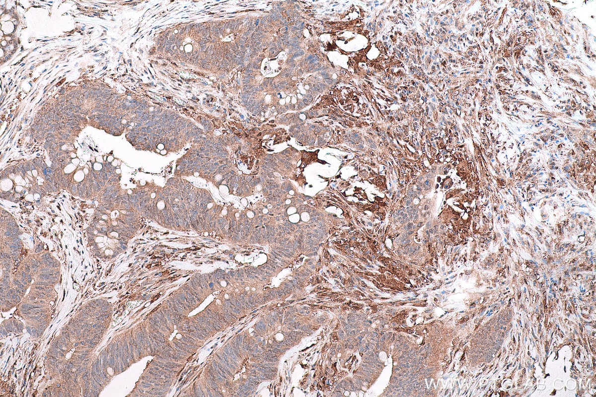 Immunohistochemical analysis of paraffin-embedded human colon cancer tissue slide using KHC0790 (GSTO1 IHC Kit).