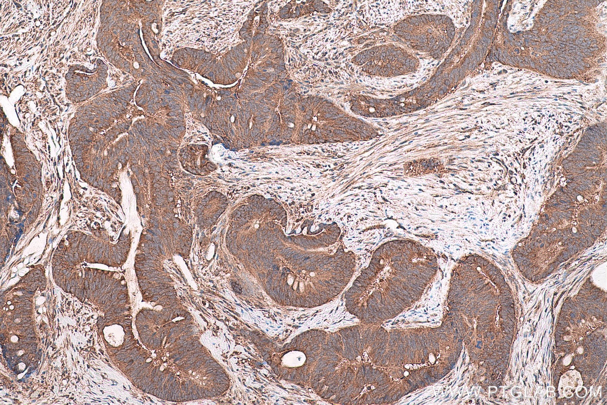 Immunohistochemical analysis of paraffin-embedded human colon cancer tissue slide using KHC0791 (GSTO2 IHC Kit).