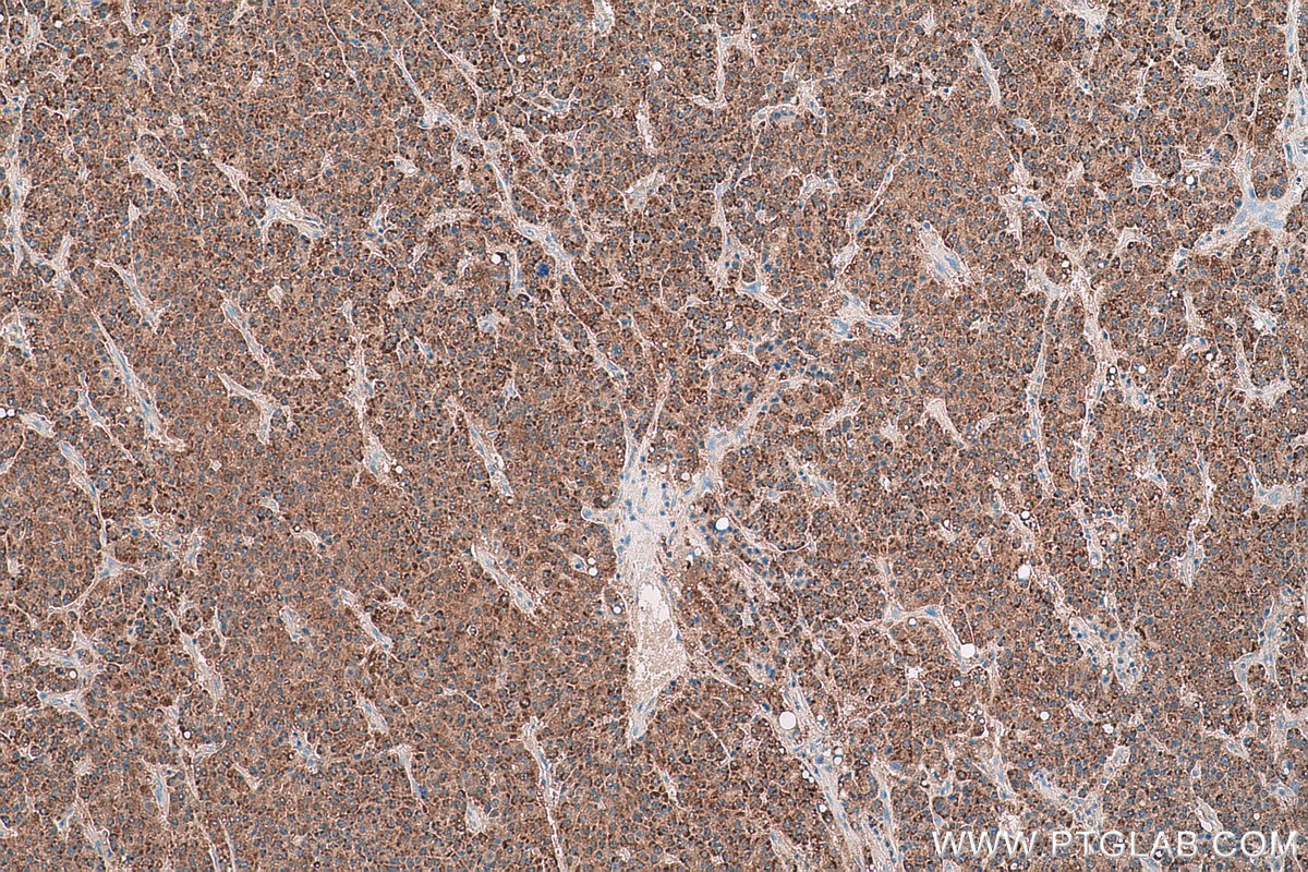 Immunohistochemical analysis of paraffin-embedded human liver cancer tissue slide using KHC0791 (GSTO2 IHC Kit).