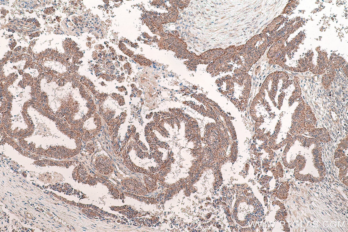 Immunohistochemical analysis of paraffin-embedded human ovary tumor tissue slide using KHC0791 (GSTO2 IHC Kit).