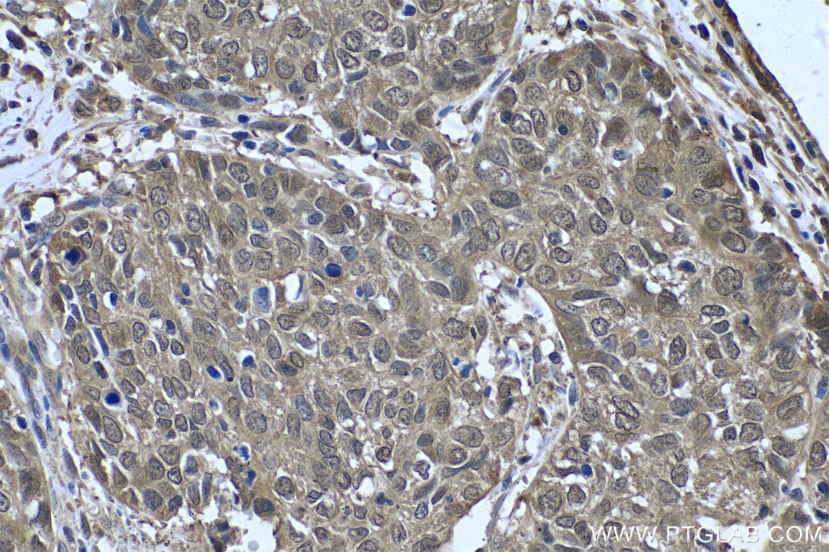 Immunohistochemical analysis of paraffin-embedded human cervical cancer tissue slide using KHC0548 (GSTP1 IHC Kit).