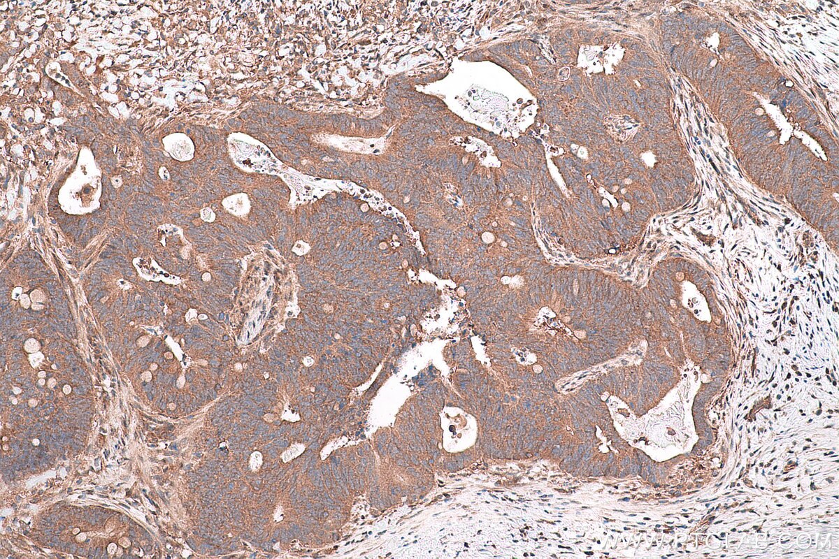 Immunohistochemical analysis of paraffin-embedded human colon cancer tissue slide using KHC0792 (GSTT2 IHC Kit).