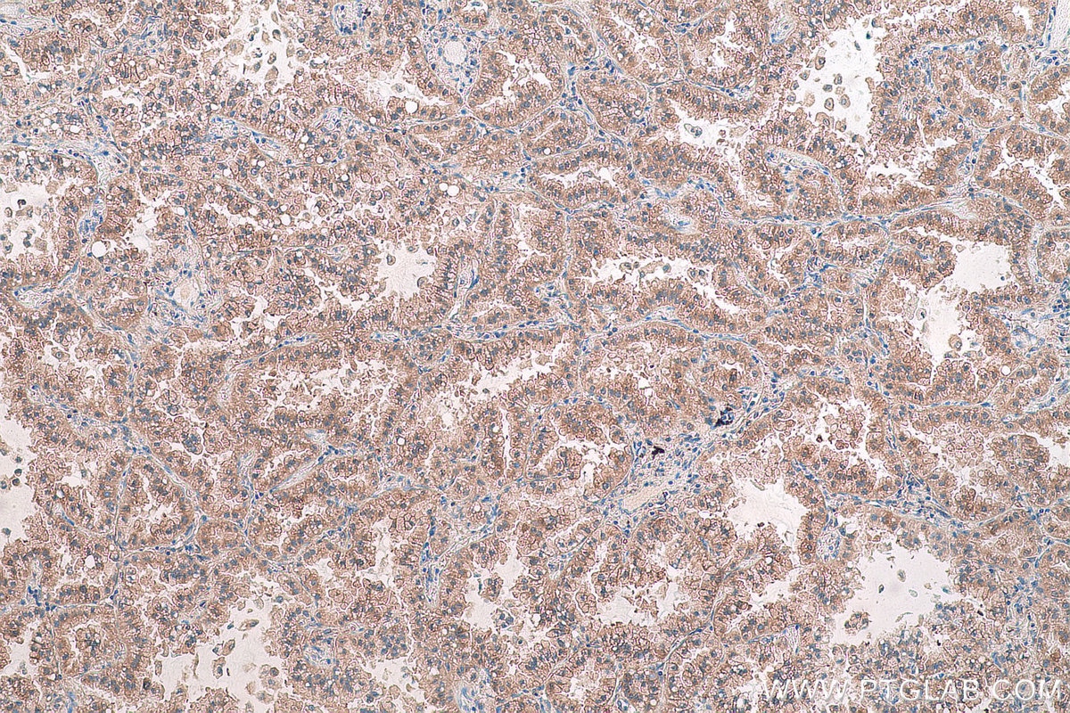 Immunohistochemical analysis of paraffin-embedded human lung cancer tissue slide using KHC0792 (GSTT2 IHC Kit).