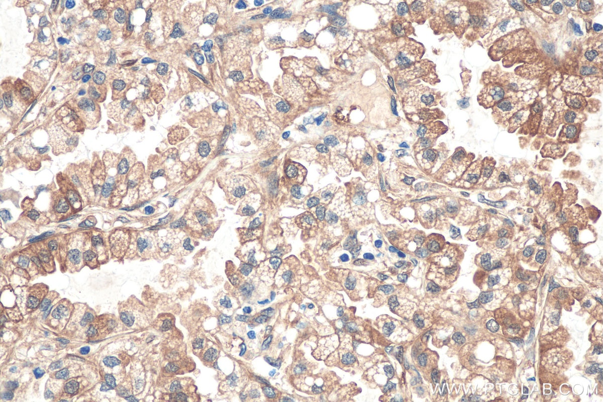 Immunohistochemical analysis of paraffin-embedded human lung cancer tissue slide using KHC0793 (GSTT2B IHC Kit).