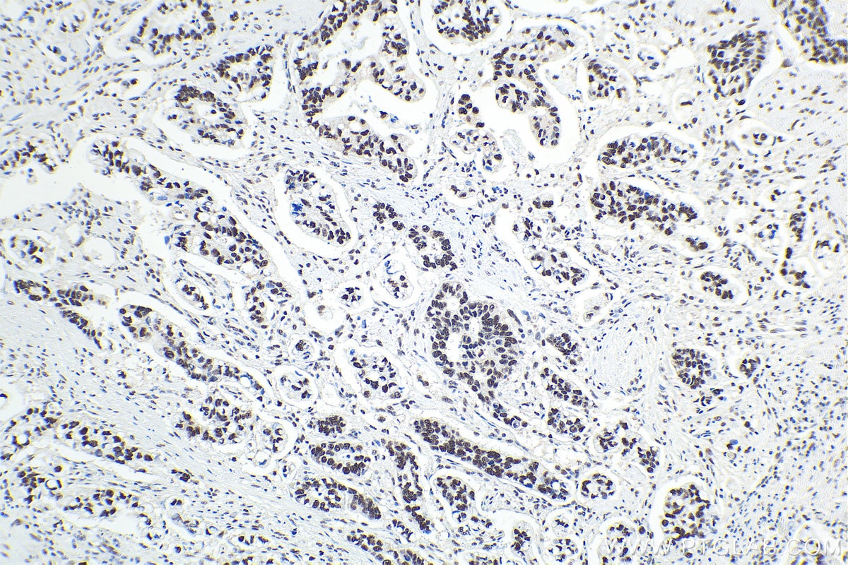 Immunohistochemical analysis of paraffin-embedded human stomach cancer tissue slide using KHC1604 (GTF2E1 IHC Kit).