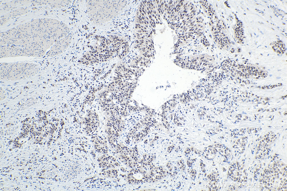 Immunohistochemical analysis of paraffin-embedded human urothelial carcinoma tissue slide using KHC1604 (GTF2E1 IHC Kit).