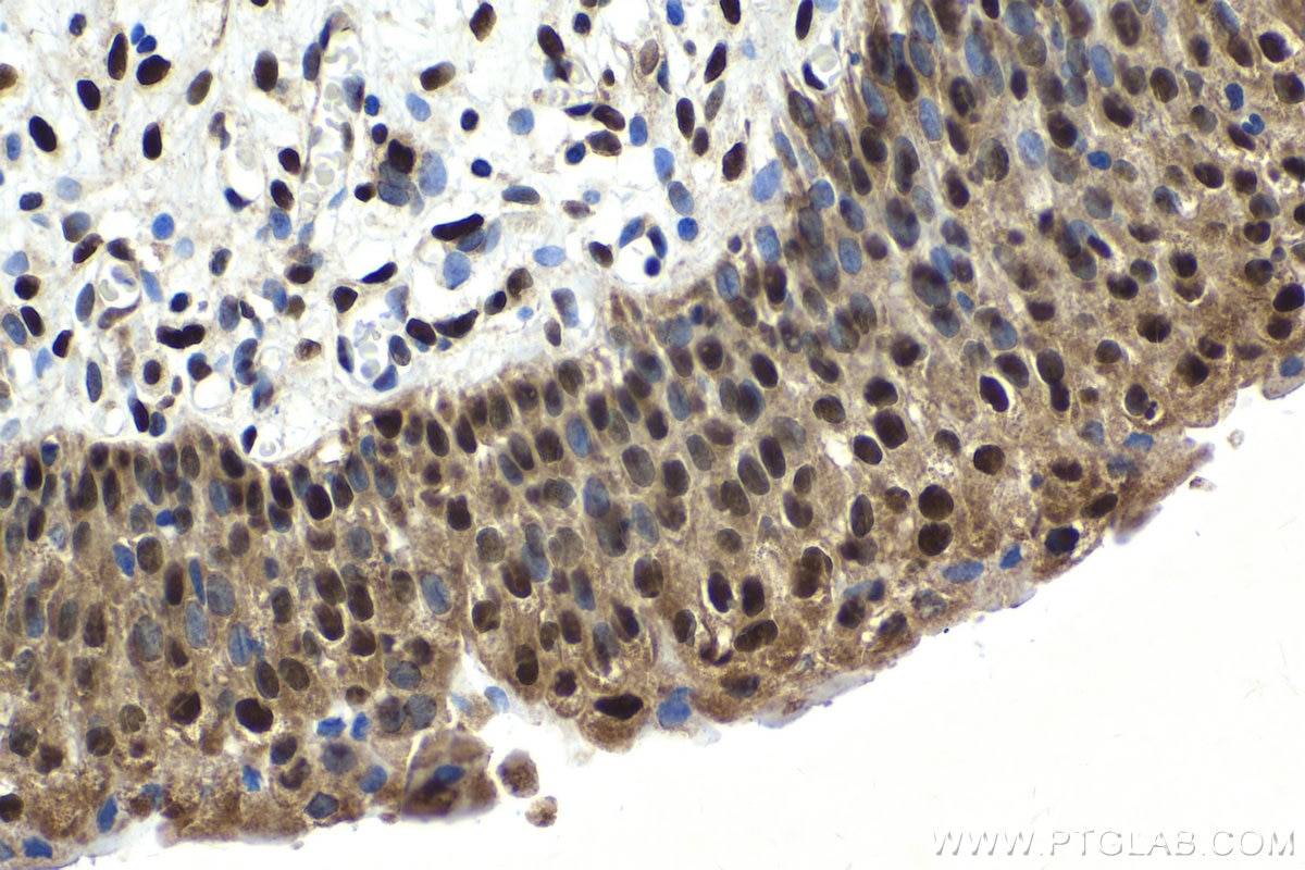 Immunohistochemical analysis of paraffin-embedded human urothelial carcinoma tissue slide using KHC1653 (GTF2I IHC Kit).