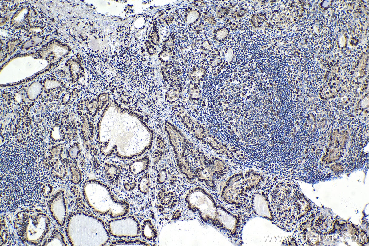 Immunohistochemical analysis of paraffin-embedded human thyroid cancer tissue slide using KHC1653 (GTF2I IHC Kit).