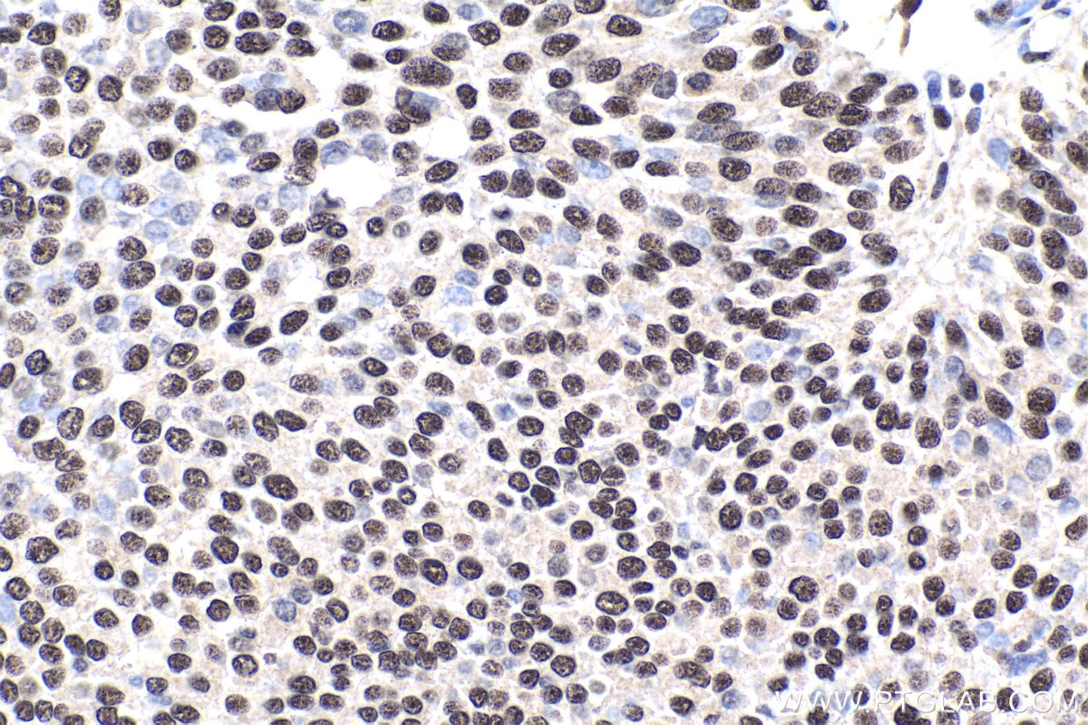 Immunohistochemical analysis of paraffin-embedded human urothelial carcinoma tissue slide using KHC1864 (GTF3C6 IHC Kit).
