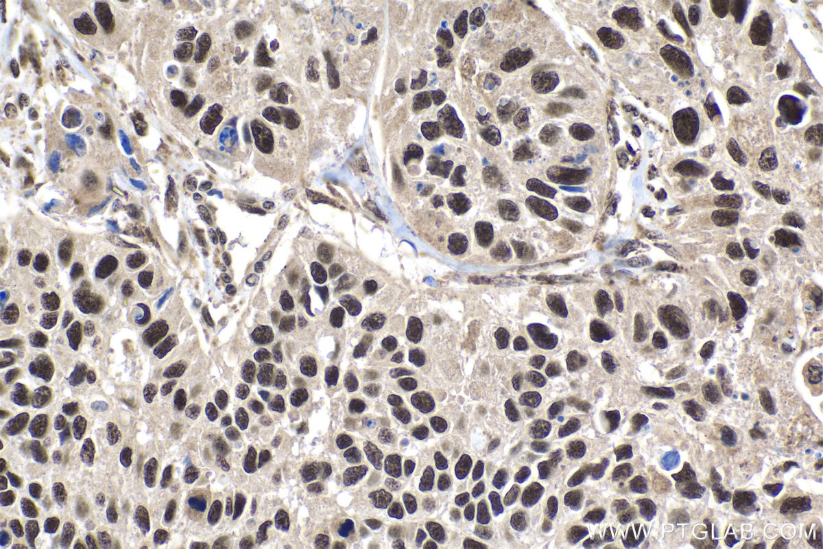 Immunohistochemical analysis of paraffin-embedded human lung cancer tissue slide using KHC1864 (GTF3C6 IHC Kit).