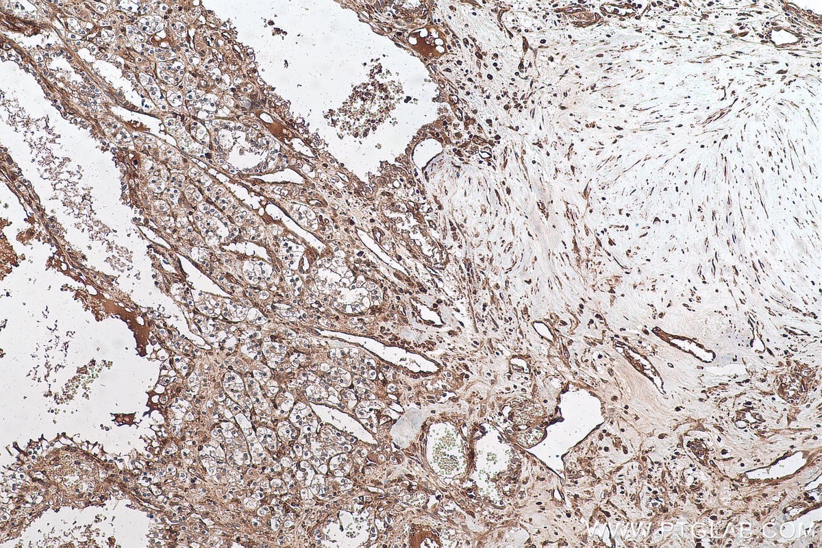 Immunohistochemical analysis of paraffin-embedded human renal cell carcinoma tissue slide using KHC0904 (GYG1 IHC Kit).