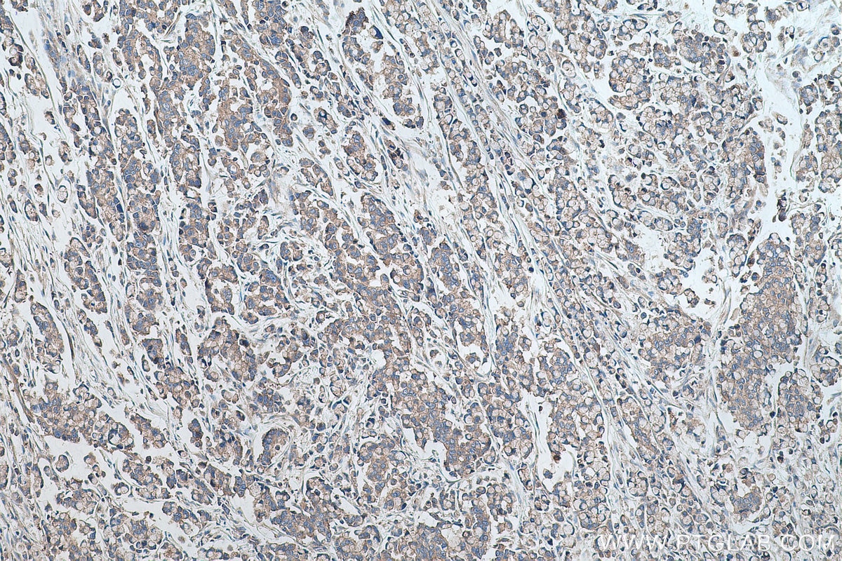 Immunohistochemical analysis of paraffin-embedded human colon cancer tissue slide using KHC0498 (GYS1 IHC Kit).