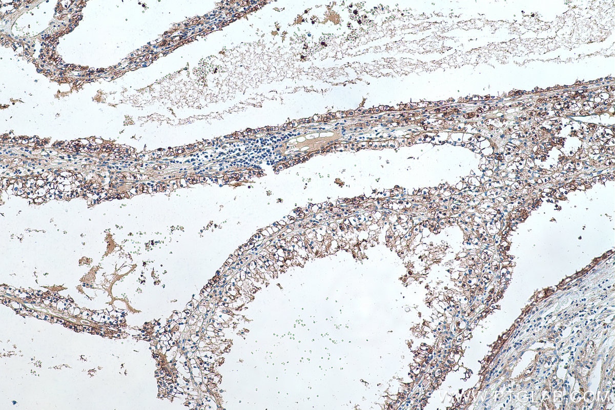 Immunohistochemical analysis of paraffin-embedded human renal cell carcinoma tissue slide using KHC0498 (GYS1 IHC Kit).
