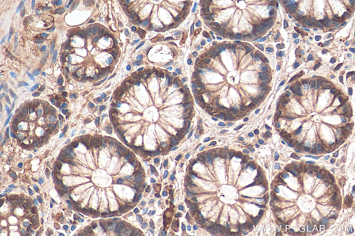 Immunohistochemical analysis of paraffin-embedded human colon cancer tissue slide using KHC0035 (Galectin-3 IHC Kit).