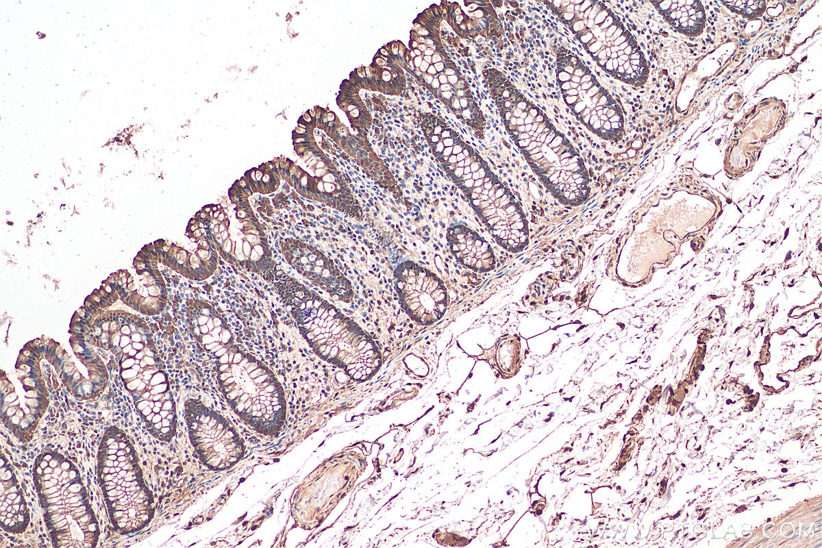 Immunohistochemical analysis of paraffin-embedded human colon cancer tissue slide using KHC0035 (Galectin-3 IHC Kit).