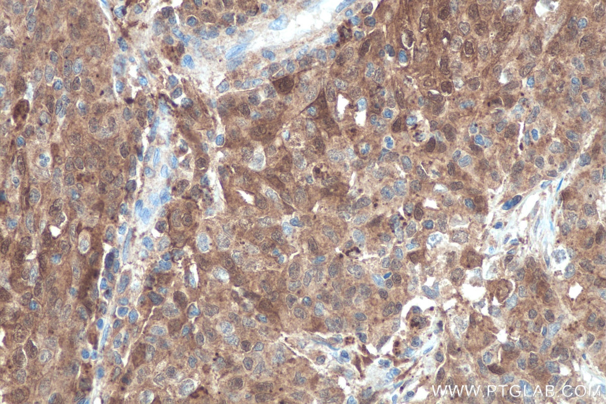 Immunohistochemical analysis of paraffin-embedded human stomach cancer tissue slide using KHC0035 (Galectin-3 IHC Kit).