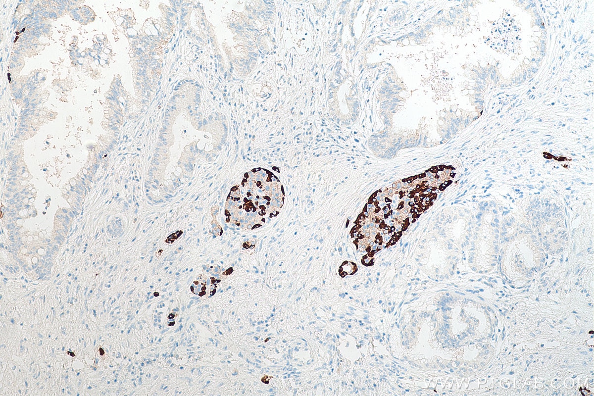 Immunohistochemical analysis of paraffin-embedded human pancreas cancer tissue slide using KHC0005 (Glucagon IHC Kit).