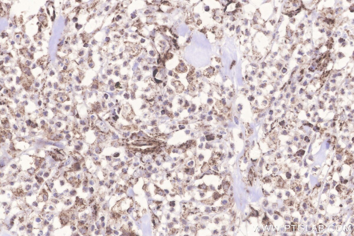 Immunohistochemical analysis of paraffin-embedded human colon cancer tissue slide using KHC3282 (Glutaredoxin 5 IHC Kit).