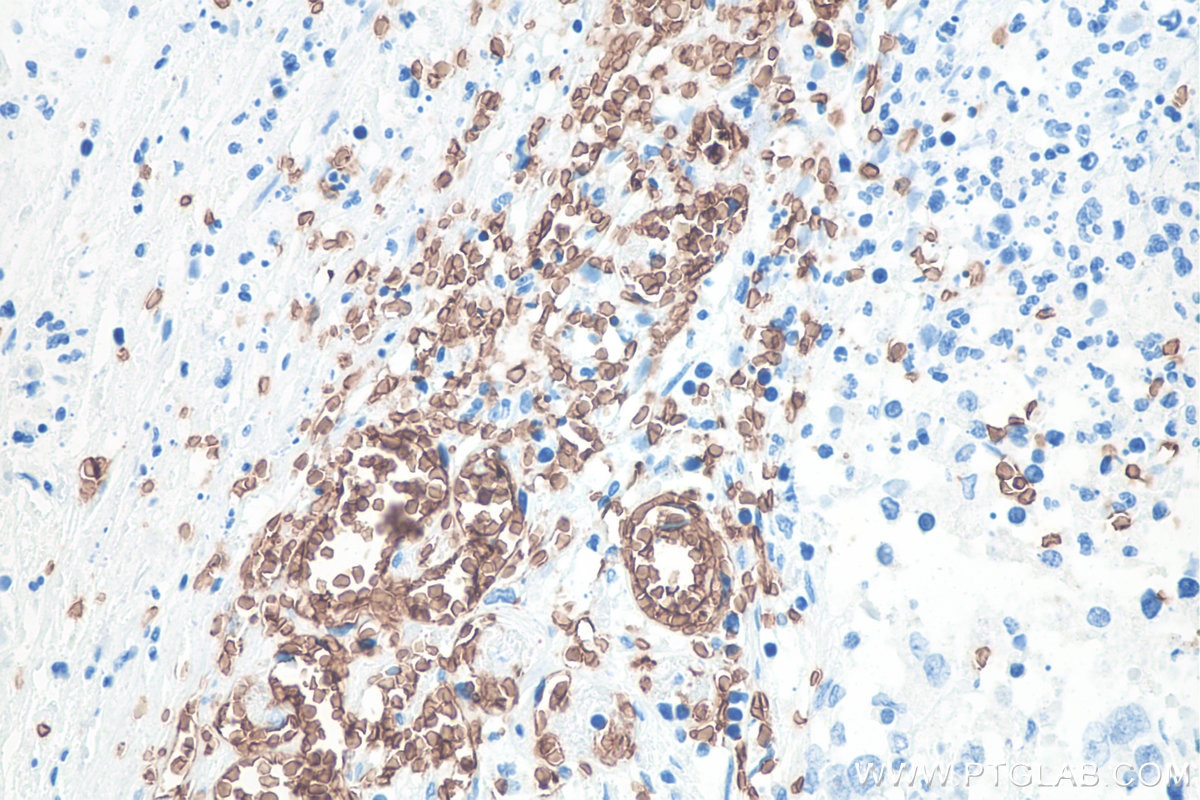 Immunohistochemical analysis of paraffin-embedded human stomach cancer tissue slide using KHC0076 (Glycophorin A  IHC Kit).