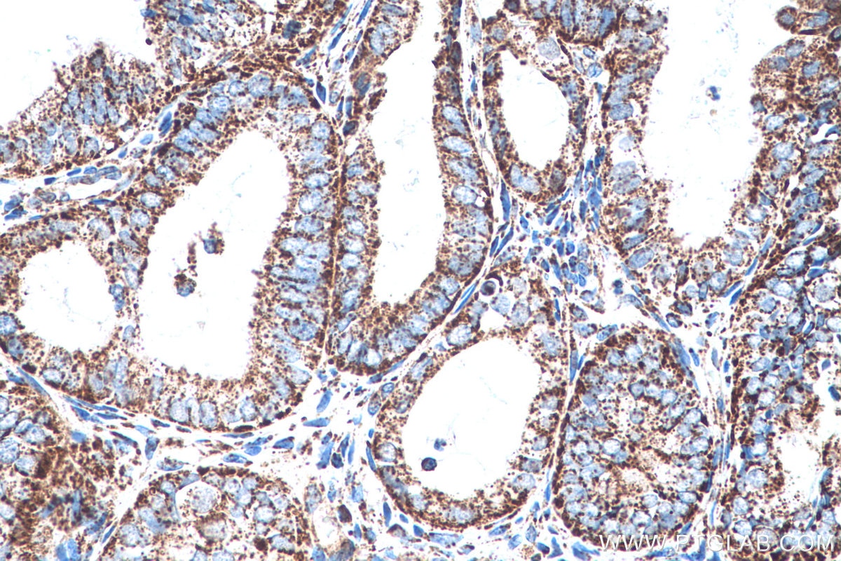Immunohistochemical analysis of paraffin-embedded human ovary tumor tissue slide using KHC0552 (HADH IHC Kit).