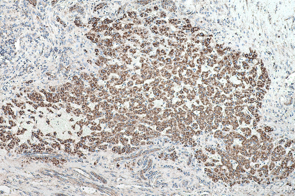 Immunohistochemical analysis of paraffin-embedded human liver cancer tissue slide using KHC0553 (HADHA IHC Kit).