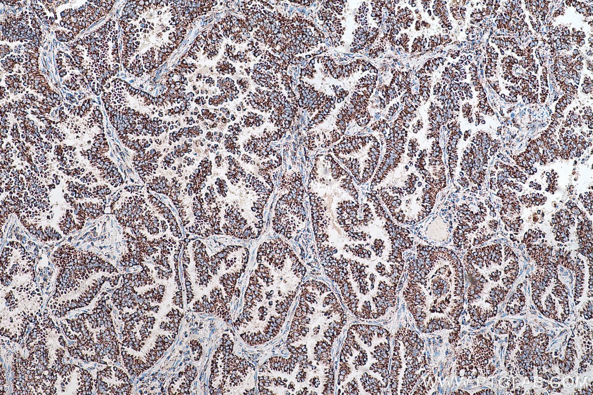 Immunohistochemical analysis of paraffin-embedded human lung cancer tissue slide using KHC0553 (HADHA IHC Kit).