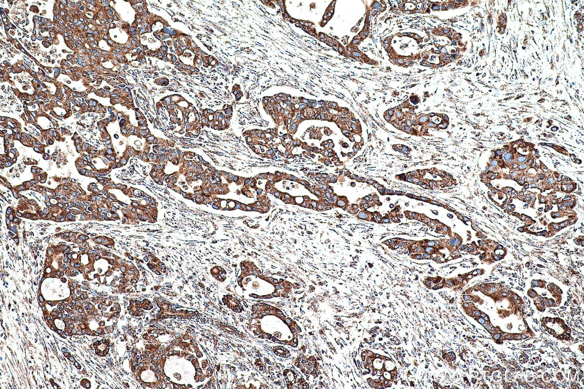 Immunohistochemical analysis of paraffin-embedded human pancreas cancer tissue slide using KHC0553 (HADHA IHC Kit).