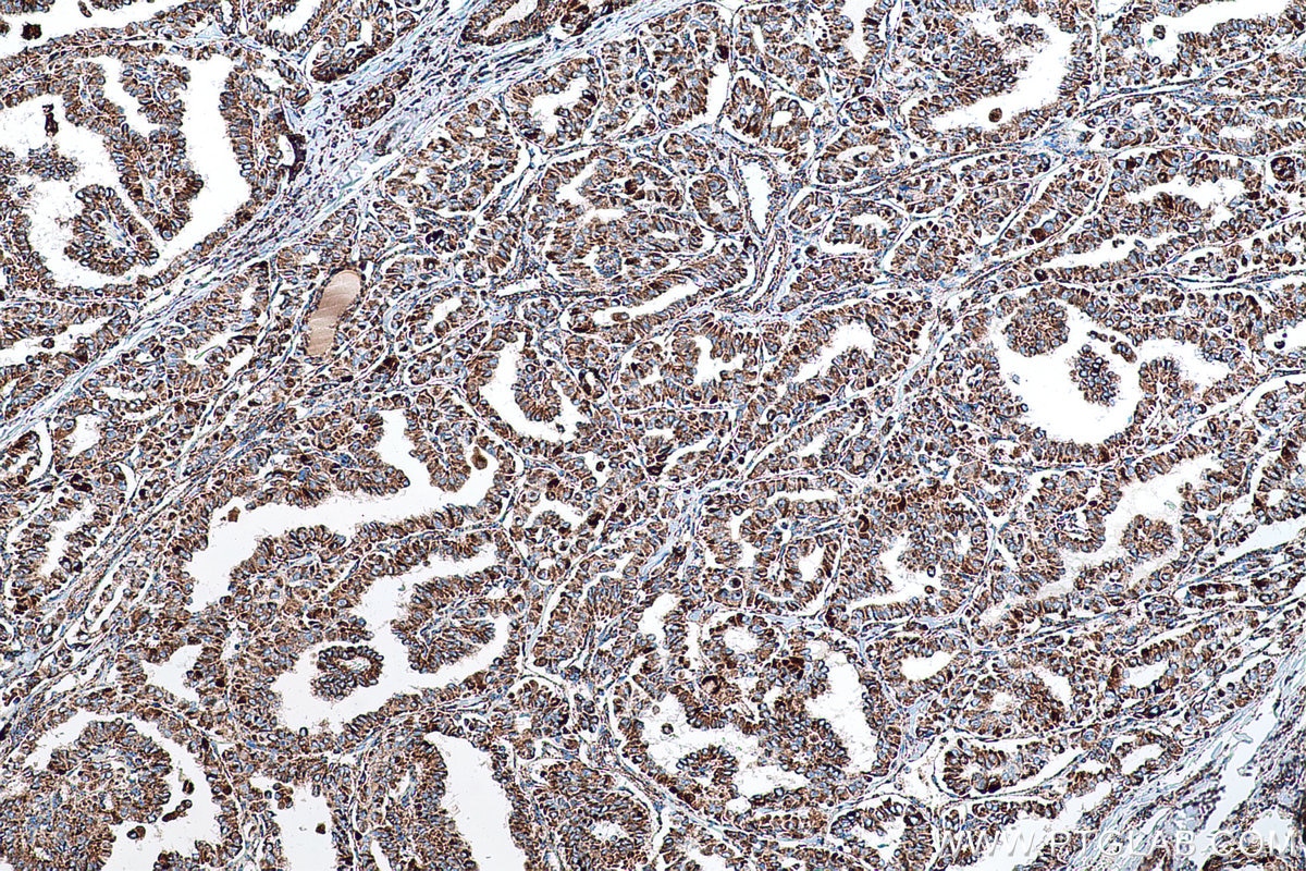 Immunohistochemical analysis of paraffin-embedded human thyroid cancer tissue slide using KHC0553 (HADHA IHC Kit).
