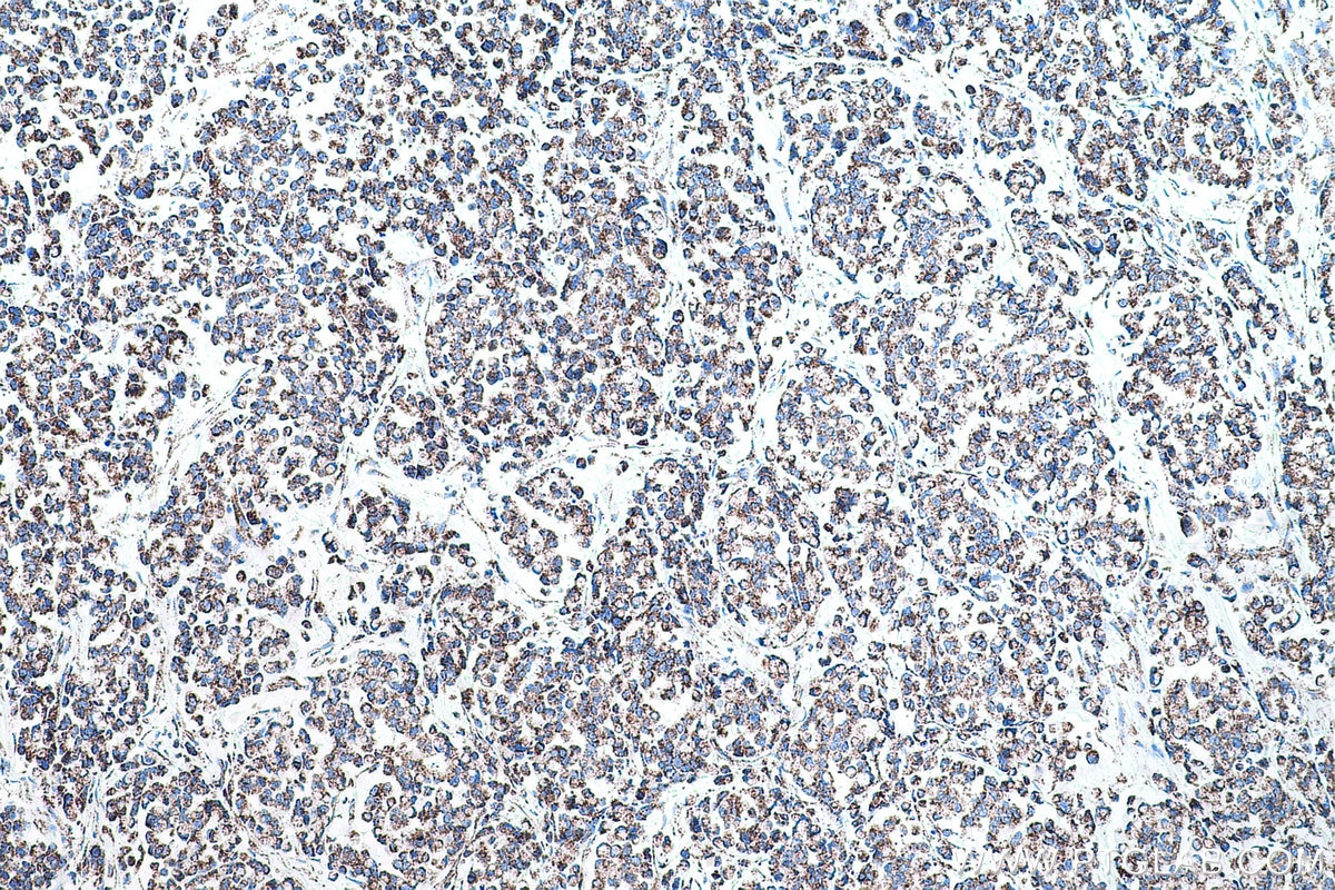 Immunohistochemical analysis of paraffin-embedded human colon cancer tissue slide using KHC0554 (HADHB IHC Kit).