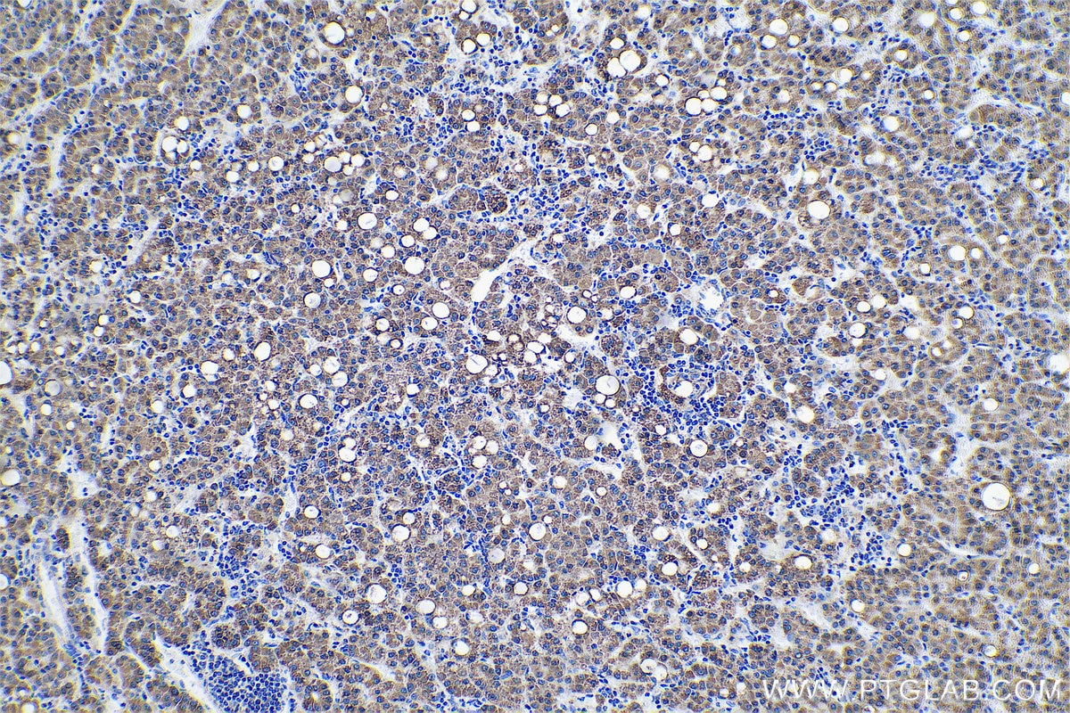 Immunohistochemical analysis of paraffin-embedded human liver cancer tissue slide using KHC0554 (HADHB IHC Kit).