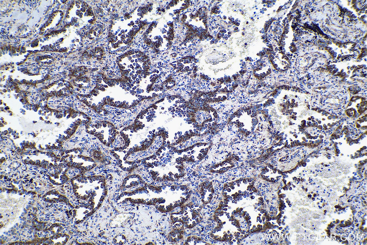 Immunohistochemical analysis of paraffin-embedded human lung cancer tissue slide using KHC0554 (HADHB IHC Kit).