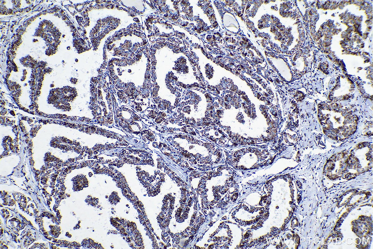 Immunohistochemical analysis of paraffin-embedded human thyroid cancer tissue slide using KHC0554 (HADHB IHC Kit).