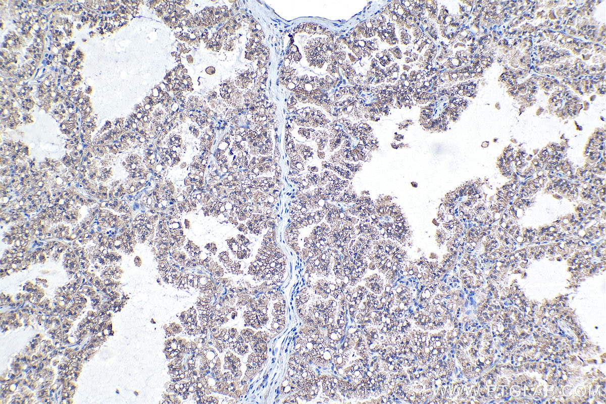 Immunohistochemical analysis of paraffin-embedded human lung cancer tissue slide using KHC1047 (HAGH IHC Kit).