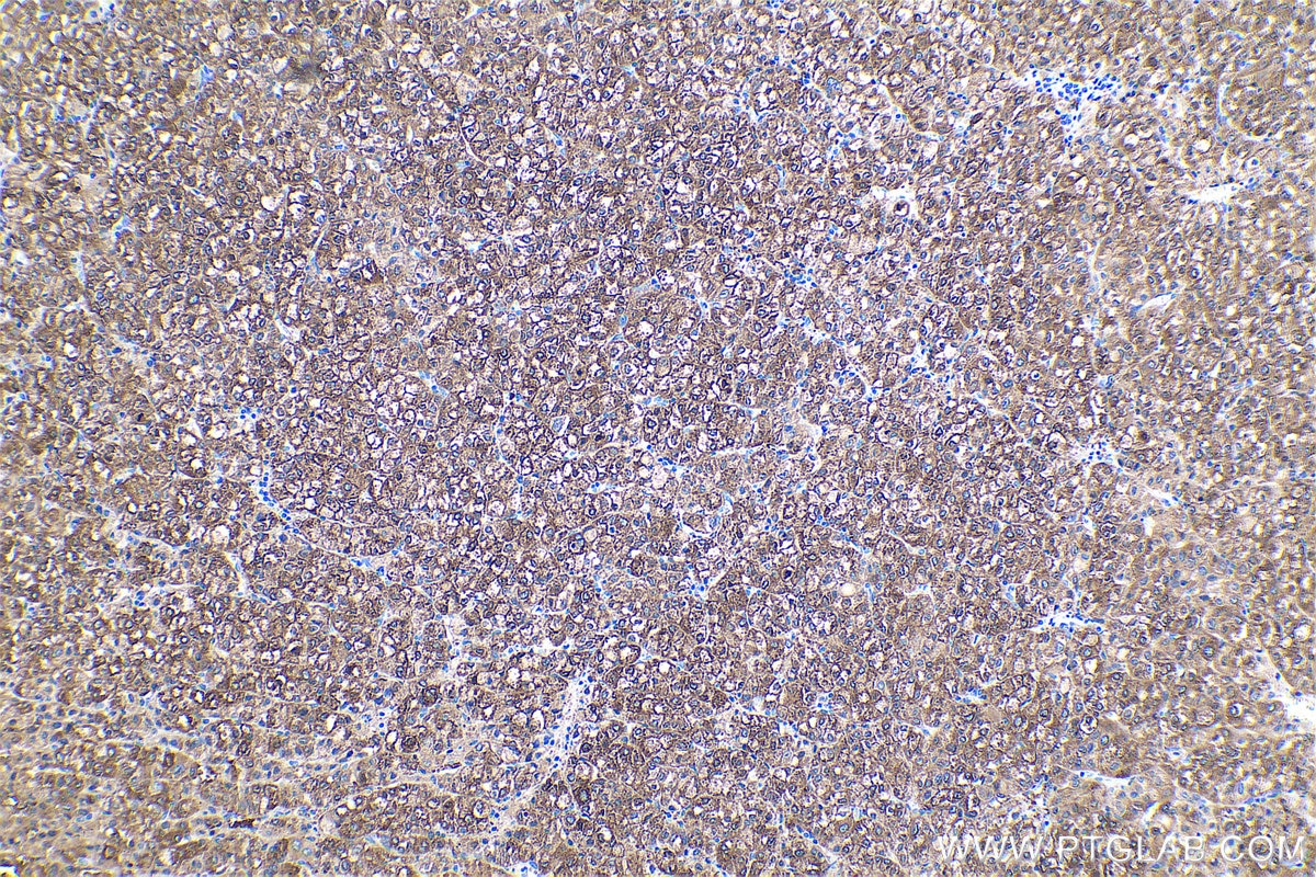 Immunohistochemical analysis of paraffin-embedded human liver cancer tissue slide using KHC0487 (HAL IHC Kit).