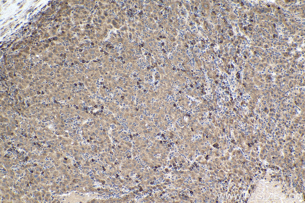 Immunohistochemical analysis of paraffin-embedded human liver cancer tissue slide using KHC1627 (HAP1 IHC Kit).